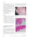 A rare repigmentation pattern in a vitiligo patient: a clue to an epidermal stem-cell reservoir of melanocytes?