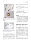 Instilled bimatoprost ophthalmic solution in patients with eyelash alopecia areata