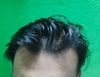 21M, Thinning on Top with Family History, Seeking Treatment Options