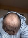M25 - Start taking meds or shave it off?