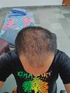 29M Starting Dutasteride and Minoxidil for Thin Crown After Long-term Hair Loss