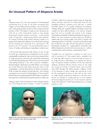 An Unusual Pattern of Alopecia Areata