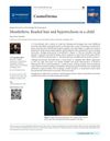 Monilethrix: Beaded Hair and Hypotrichosis in a Child