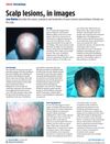 Scalp Lesions: Causes, Symptoms, and Treatments