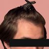 23M Considering Finasteride/Minoxidil for Receding Hairline Since High School