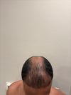 Seeking Advice After FUT Hair Transplant in 2021 – Considering FUE