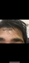 27M: Dutasteride and Minoxidil for Eyebrow Thinning and Hair Loss, Seeking Advice