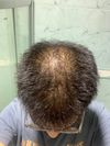 15-Year-Old Seeking Advice on Rapid Hair Thinning on Crown