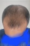 Shave it or treat it need advise on mpb genetic