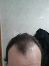 M26 Regrowth Journal [0.5mg dut + 5mg oral minoxidil]
