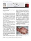 Successful Induction of Oral Tolerance in Netherton Syndrome