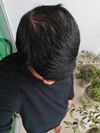 What should I do 18M facing extreme hair thining and dandruff
