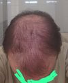 From almost 0 to ?: A journey through hair regrowth - big 4