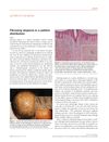 Fibrosing Alopecia in a Pattern Distribution