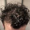 That’s it i’m starting oral Minoxidil