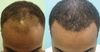 Best reversing hairloss protocol i&rsquo;v seen - do you trust it?