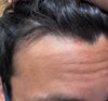18M Seeking Norwood Classification for My Hairline with Photos