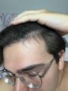 Concerned About Worsening Hairline 4 Months into Minoxidil Use