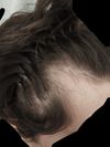 Should I Seek a Second Opinion on Finasteride at 22?