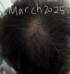 Minoxidil foam (5%) one year progress (male, age 23)