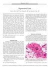 Pigmented Casts in Alopecia: A 2014 Study