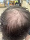 21M Considering Hair Growth Pills and Dermatologist for Balding Prevention