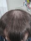24&hellip; just noticed my thinning almost one month ago. Feel like losing hope