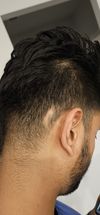 Patch Behind Ear Possibly Due to Glasses, Is it Traction Alopecia?