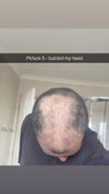 24M: Lack of Progress After 4 Years on Fin/Min/Keto and Recent Shed