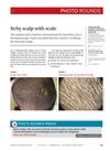 Itchy Scalp with Scale