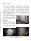 Alopecia Areata: Comprehensive Overview and Histological Characteristics