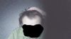Reevaluating Finasteride/RU After 4 Months: Should I Switch to Dut?