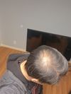 42M, 1.5 Years on Minoxidil, Starting Finasteride &amp; Microneedling - Is Regrowth Possible?