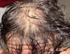 26M 2 years on 1mg Finasteride only, hair stabilized but still thinning, should I add Oral Minoxidil?