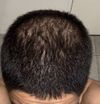 Losing ground on finasteride after only 2 years of really good results?