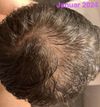 No progress after 8 months Finasteride &amp; 2.5 years Minoxidil – need help