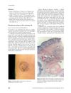 Pilomatricoma Arising at a BCG Vaccination Site