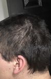 Can Shampoo Treat Suspected Fungal Hair Loss?
