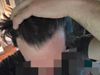 35M: Irregular Fin Use, Seeking Alternatives to Minoxidil and Fin