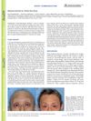 Alopecia Induced by Timolol Eye-Drops