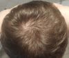 Considering Minoxidil with Finasteride Started in April