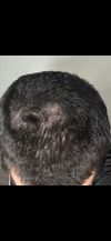 17m Seeking Second Opinion on Hair Thinning and Receding Temples