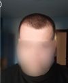 29M with Hypothyroidism: Minoxidil, Finasteride, or Hair Transplant for Receding Hairline?