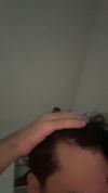 21M Seeking Advice on Finasteride and Minoxidil for Hair Loss