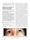Hypertrichosis of Vellus Hairs in the Malar Region After Unilateral Treatment with Bimatoprost