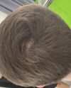 25M: Increased Hair Fall After 4 Years on Dutasteride and Minoxidil, Need Advice on Next Steps