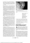 Regrowth of Alopecia Areata Simulating the Pattern of Androgenetic Alopecia