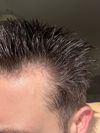 “Mature Hairline” or Genuine AGA?