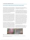Laser Hair Removal in Alopecia Areata of the Scalp: A Novel Therapeutic Approach