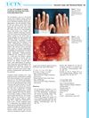 A Case of Cronkhite-Canada Syndrome Involving the Entire Gastrointestinal Tract